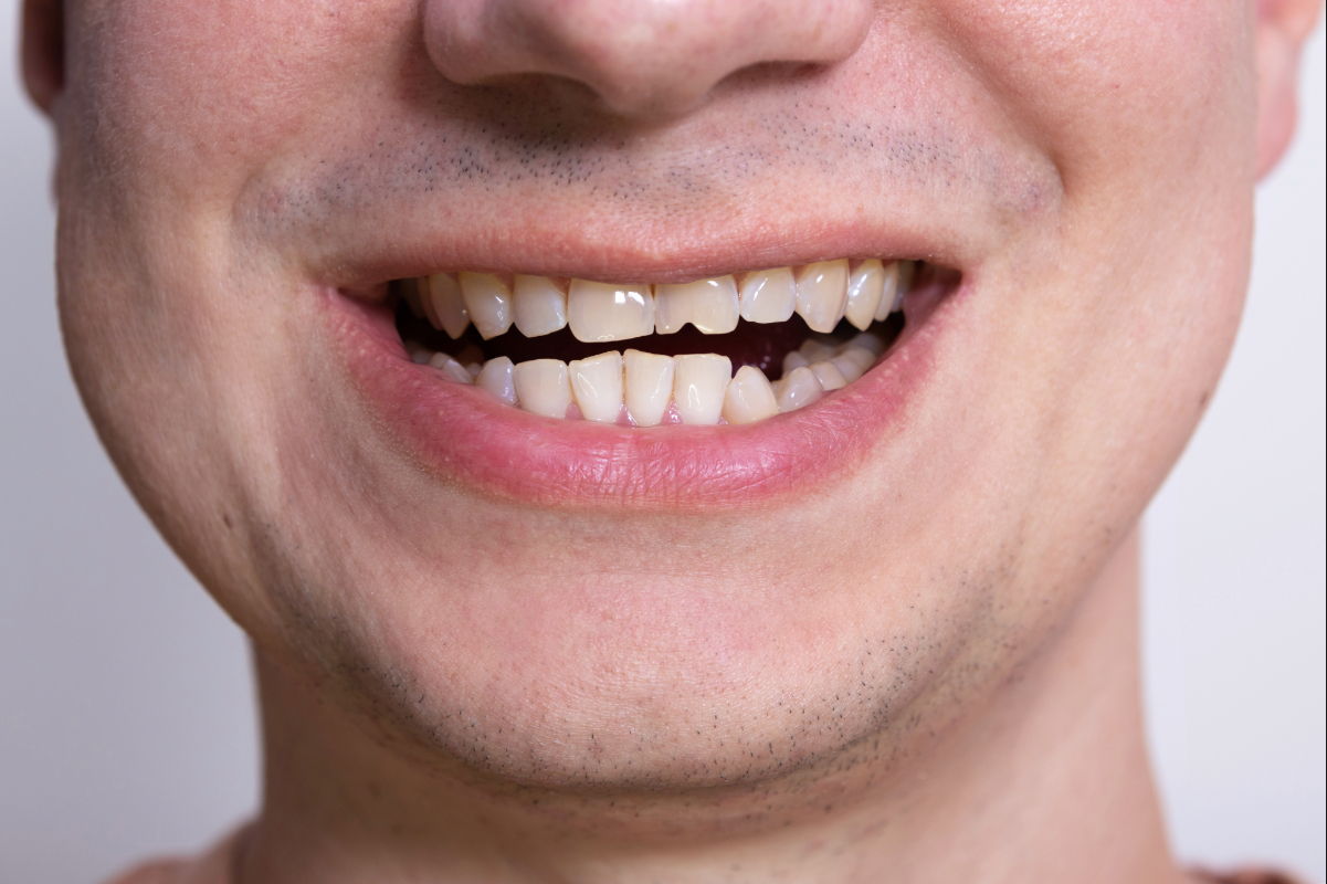 Can Chipped Teeth Grow Back? Understanding Causes, Myths & Dental Care