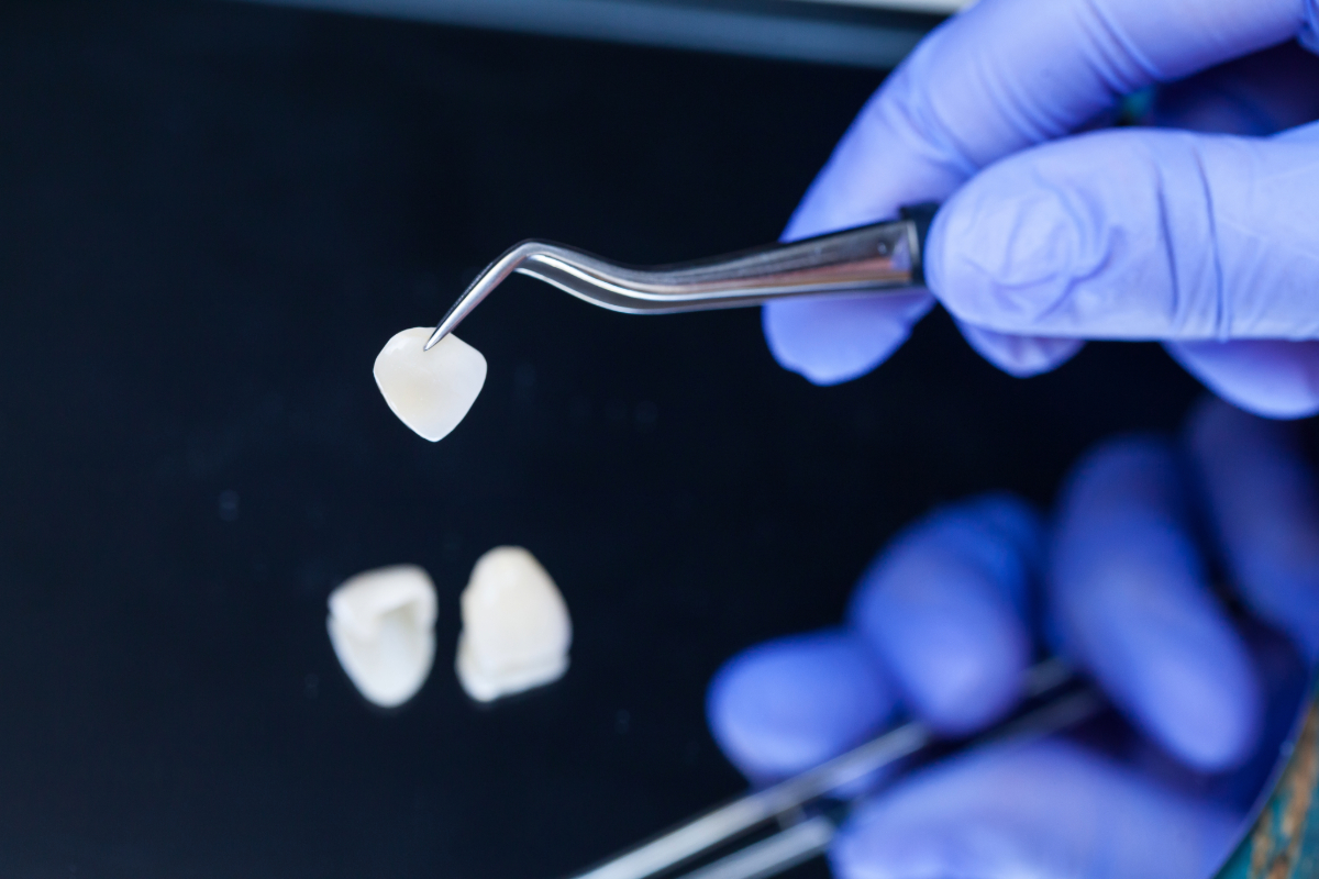 Custom porcelain veneers crafted in the in-house lab at Dentistry Today, Huntsville AL