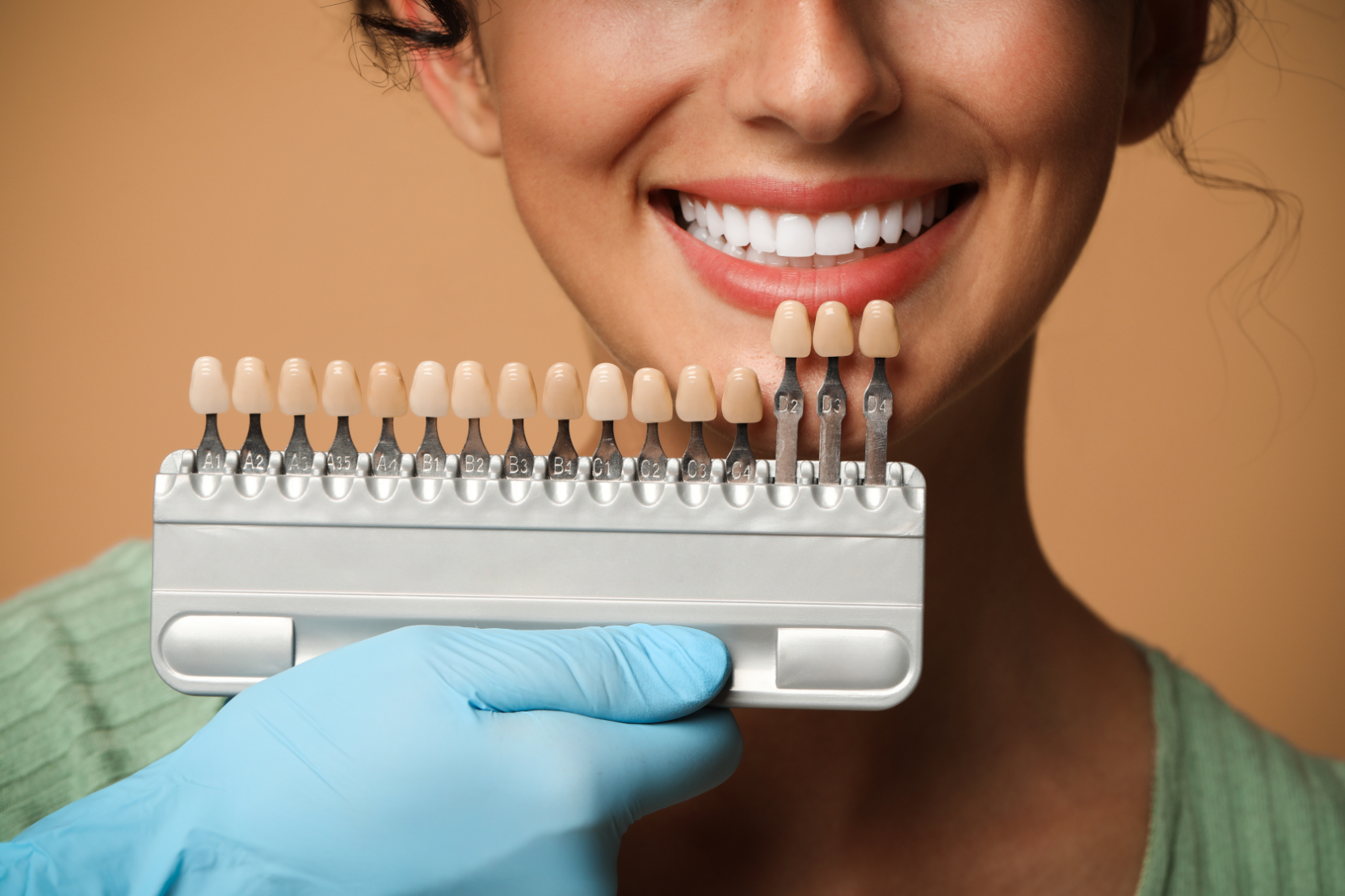 A tooth shade chart used to colour-match veneers